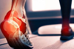 تاندونیت آشیل