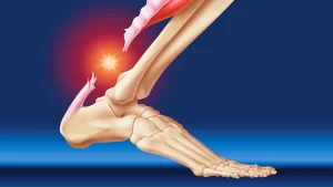 پارگی تاندون آشیل