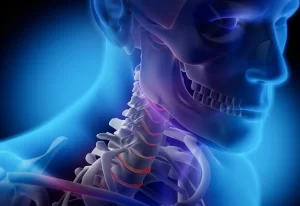 پارگی دیسک گردن