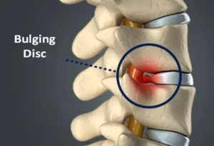 دیسک کمر خفیف